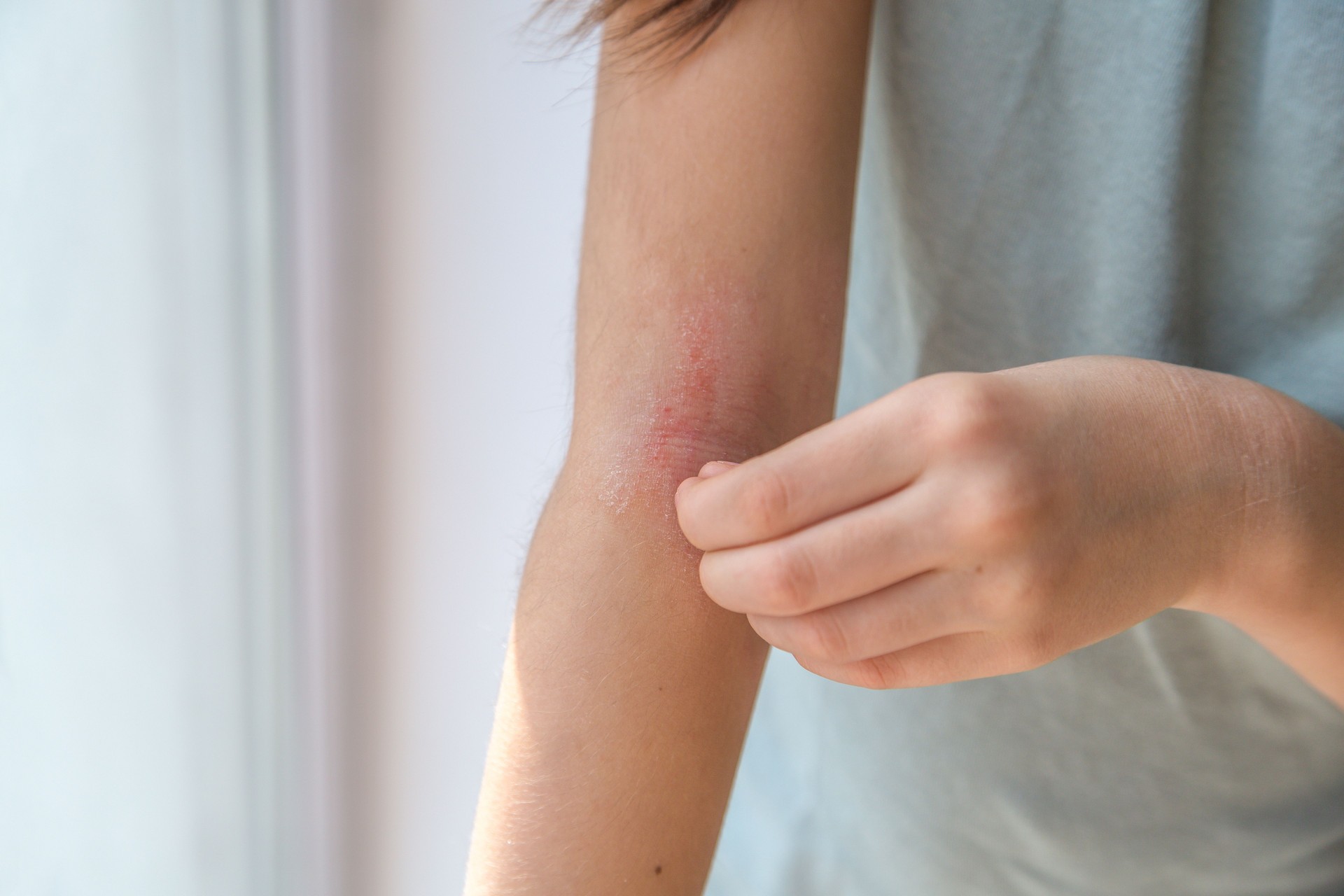 psoriasis